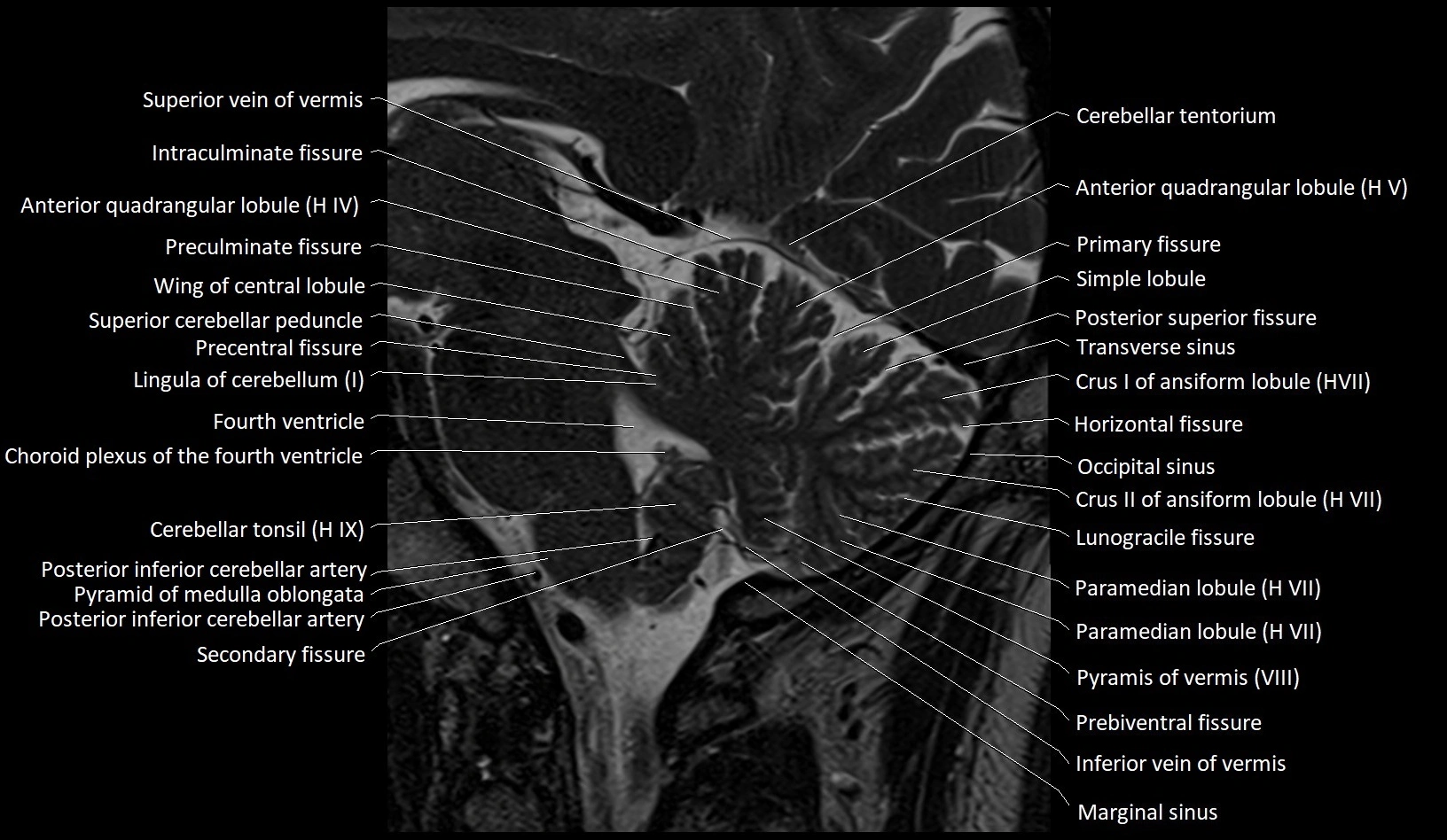 MRI Cerebellar anatomy sagittal High-resolution labelled image 32.webp